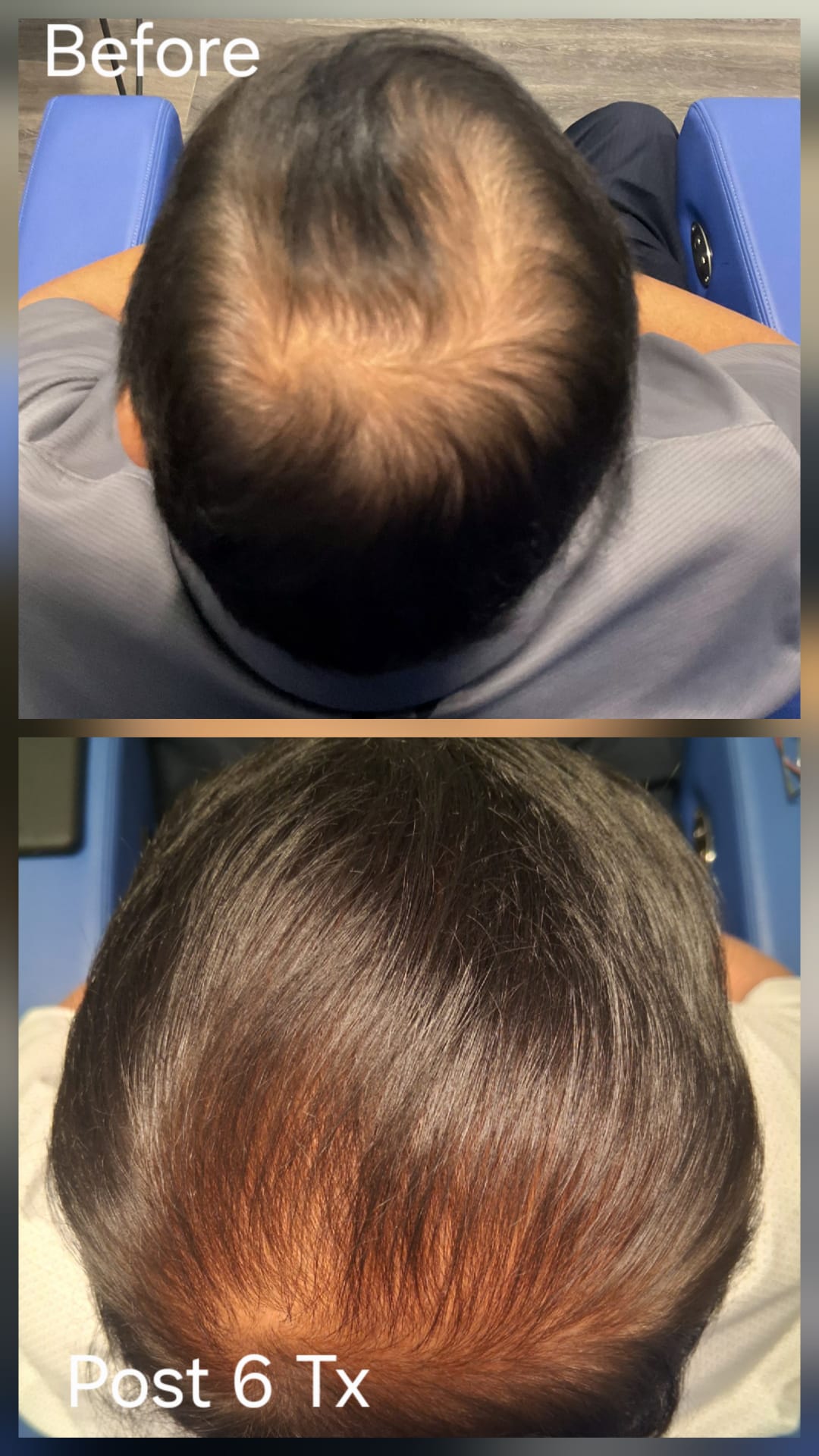 Hair restoration result